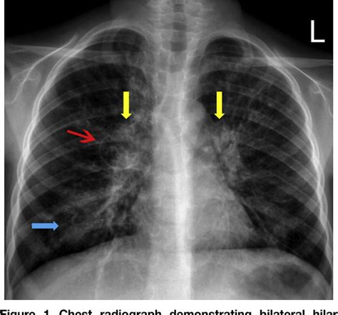 asthma x ray findings|Chest X.